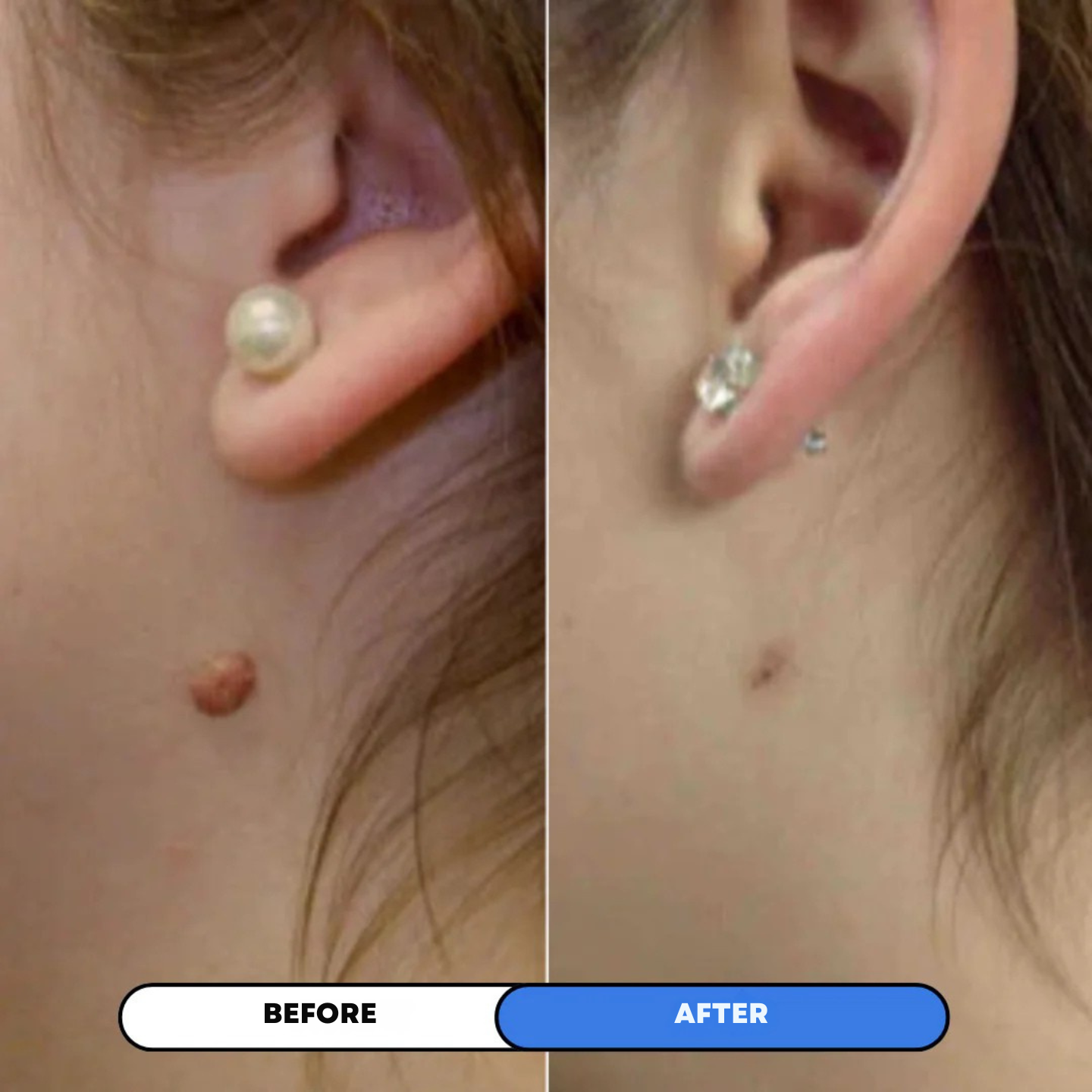 Skin Tags Removal Kit - Elaya