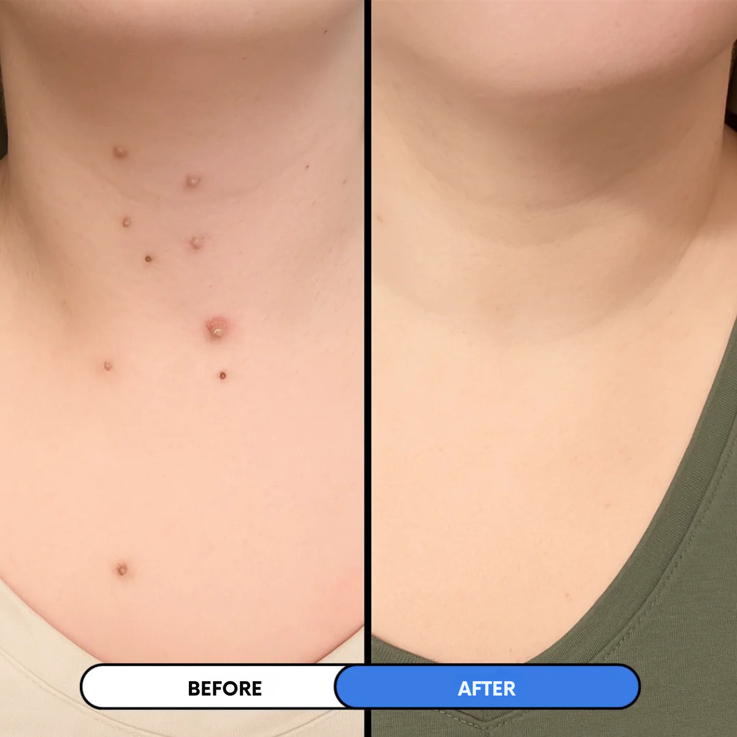 Skin Tags Removal Kit - Elaya