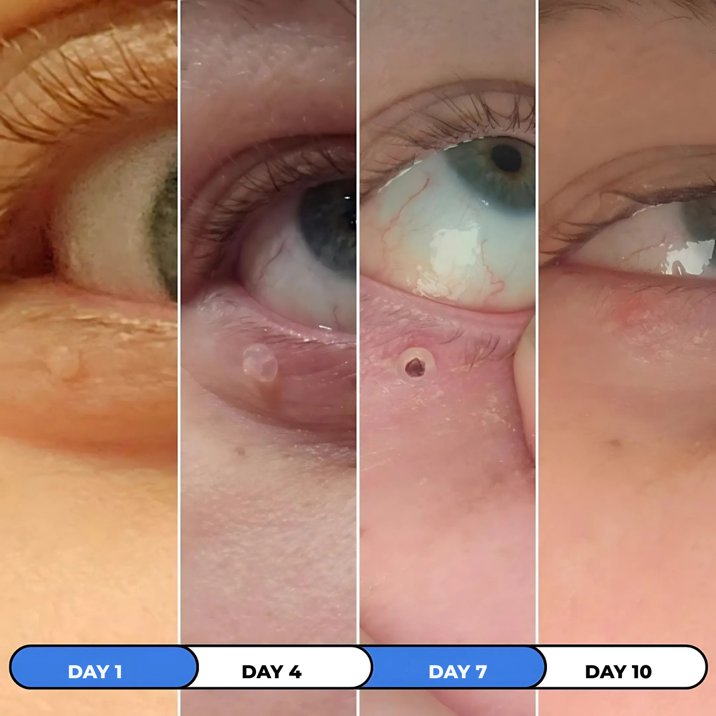 Skin Tags Removal Kit - Elaya